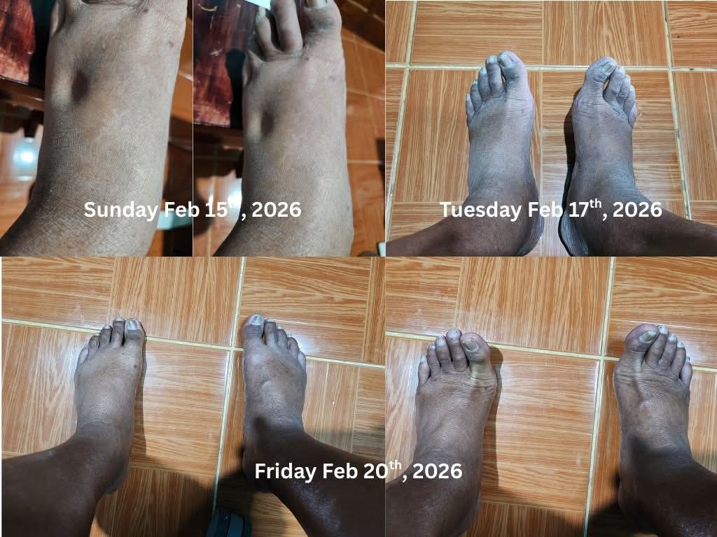 Foot swelling progress over one week